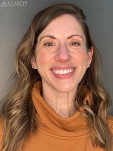 crow's feet (front)-before