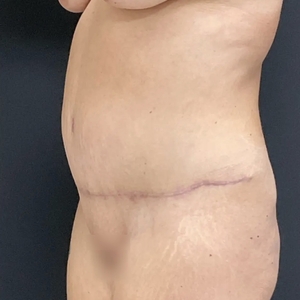 Tummy Tuck #11-after