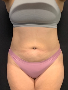 Lipo 360-after