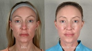 Filler ER B/A Frontal-before