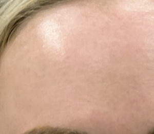 Laser Resurfacing #1-after