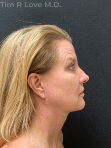 58 year old - MyEllevate, FaceTite, Morpheus8/Factora, Sculptra, Restylane Kysse-after