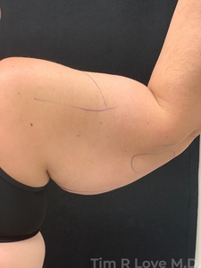 Brachioplasty-before