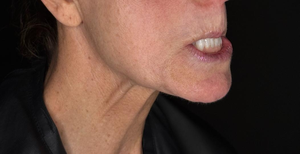 Ashley Reich RN: Platysmal Bands-after