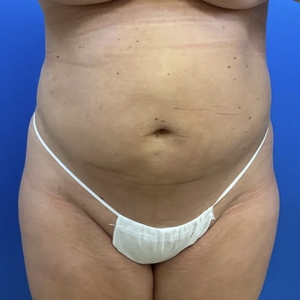 Lipo w Renuvion #3-after