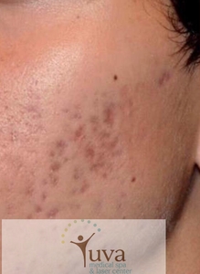 6 TX microneddling at Yuva-before