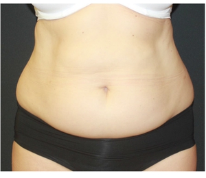 Body Contouring-after