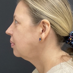 Lipo w Skin Tightening Face #3-after