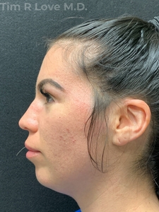 24 hour post op chin implant-before