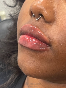 Whitney Devall RN. - Versa-after