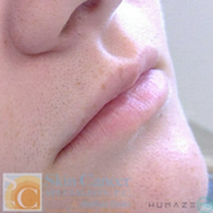 Lip Filler -before