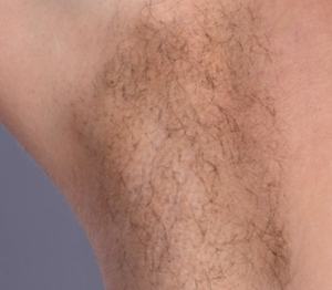 Laser Hair Removal #1-before