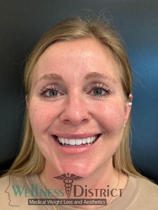 Immediately after and 60 days healed-after