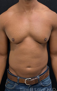 2 months post op-before