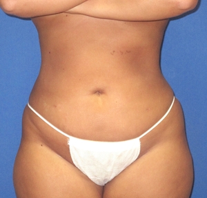 Liposuction #1-after