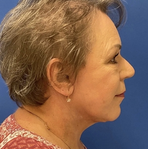 Facelift #2-after