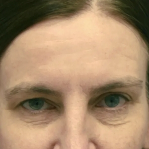 Brow & Eye Lift #1-before