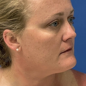 Lipo w Skin Tightening Face #7-before