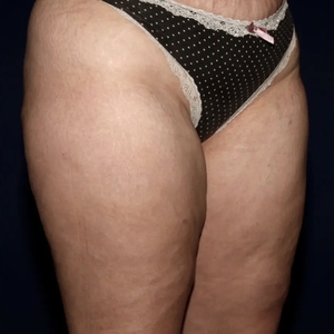 Lipo w BodyTite #7-after