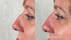Non-Surgical Rhinoplasty YB B/A-before