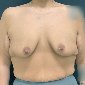 Breast Augmentation #23 435 cc-before