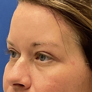 Brow & Eye Lift #2-after