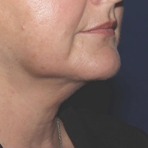 Lipo w Skin Tightening Face #5-after