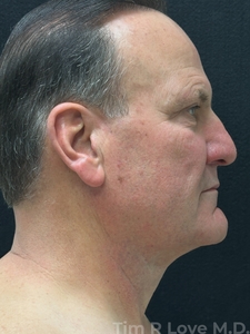 Compare-after