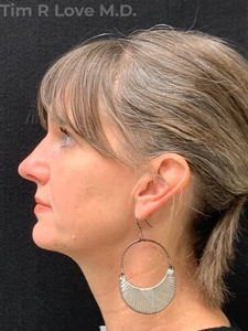 Rhinoplasty - Traditional-after