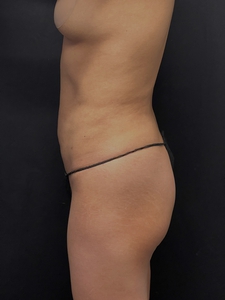 LAL-lower abdomen + waist-after