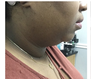 Facial Contouring-before