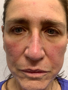 PDL for rosacea-before