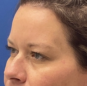 Brow & Eye Lift #2-before