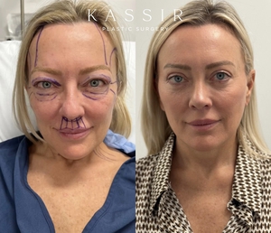 Deep Plane Face Lift NYC-before