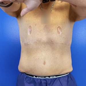 Male Breast Reduction #6-after