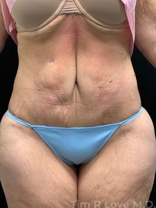 Vertical abdomen revision 5'3