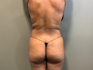Denise Strickland Posterior-before