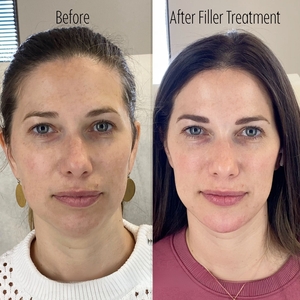 Filler B/A SBA 27-before