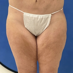 Lipo w Renuvion #1-after