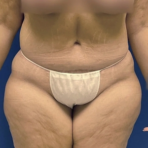 Tummy Tuck #14-after