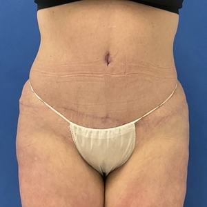 Tummy Tuck #1 (front)-after