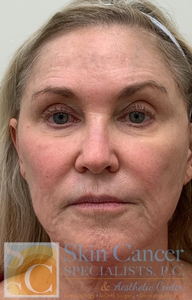Lip Filler, Threads, Cheek Filler, and Botox-before