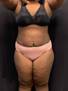Lipo 360 + mini tummy tuck-after