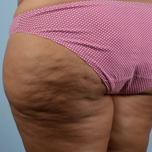 Cellulite Reduction #2-before
