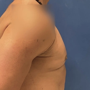 Male Breast Reduction #4-after