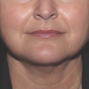 Lipo w Skin Tightening Face #5-after