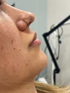 Danielle Glass RN. - Versa-before