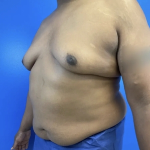 Male Breast Reduction #1-before