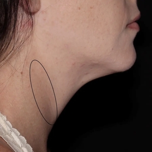 Lipo w Skin Tightening Face #4-before