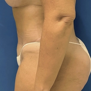 Tummy Tuck #8 (left)-after
